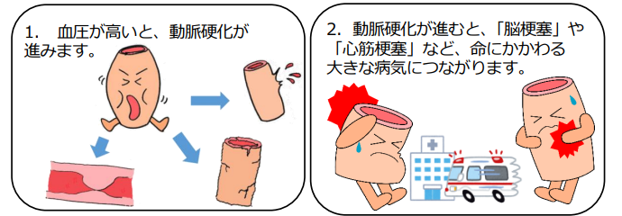血管が血圧が高くなることで動脈硬化がすすみ傷ついてしまう画像です。